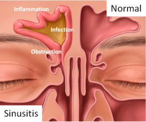 sinusitis treatment st louis