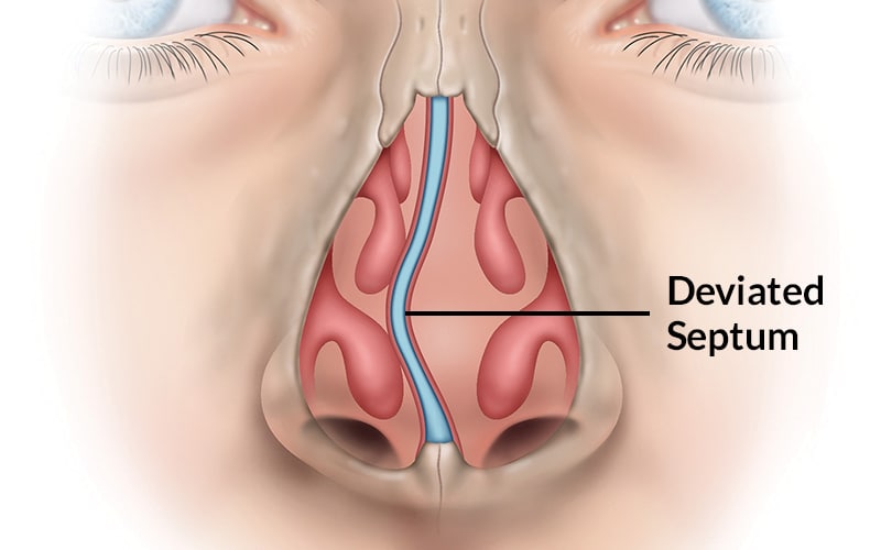 illustrated cross section of human nose with deviated septum, crooked bone in the center