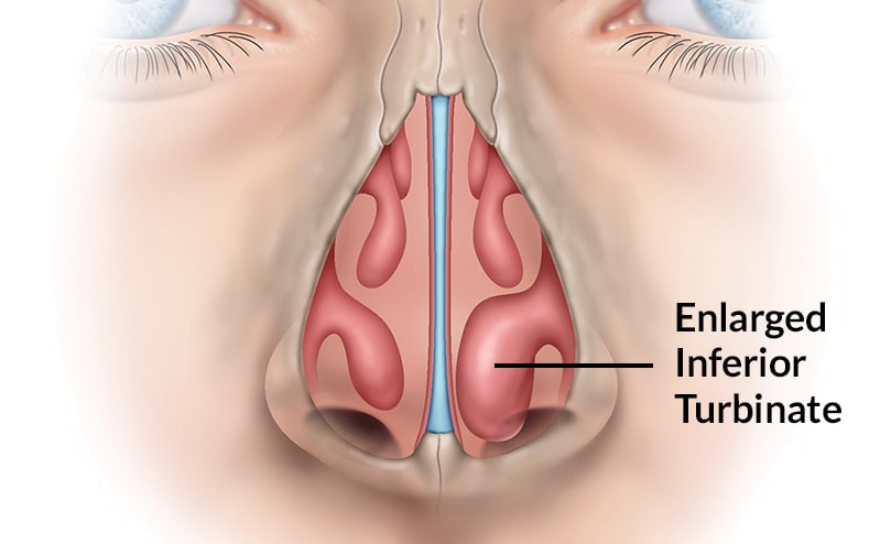 illustrated cross section of human nose showing enlarged inferior turbinate