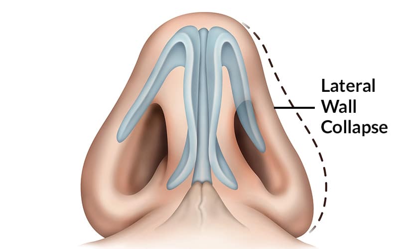 nasal problems