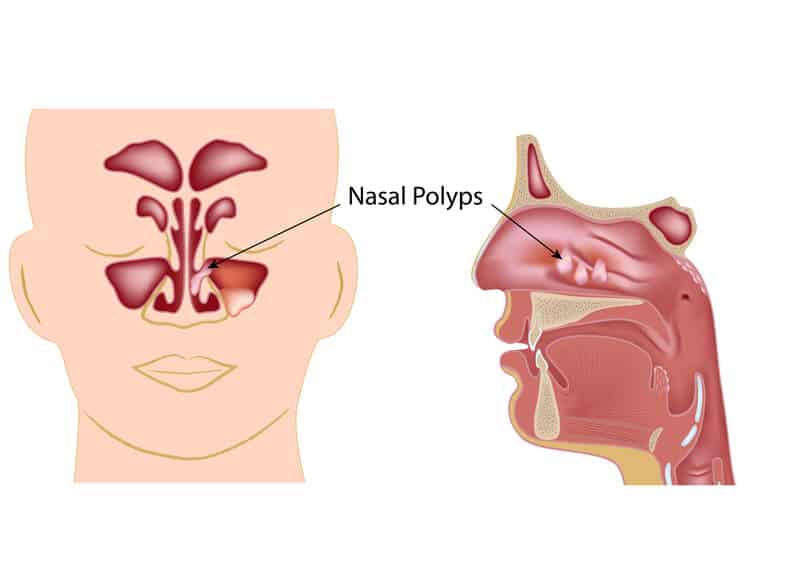 Nasal Polyps