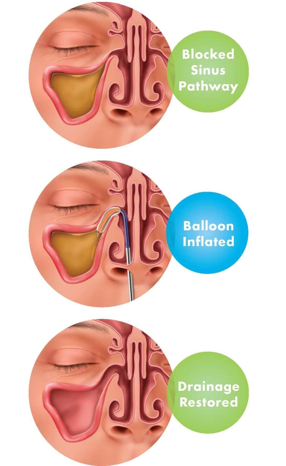 Balloon Sinus Dilation Nasal Balloon St. Louis Sinus Center