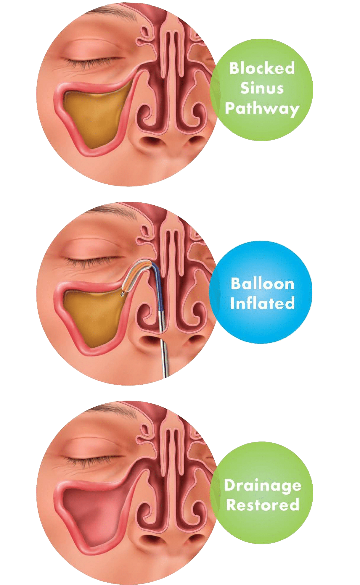 Balloon Sinuplasty St Louis Mo Balloon Sinus Dilation