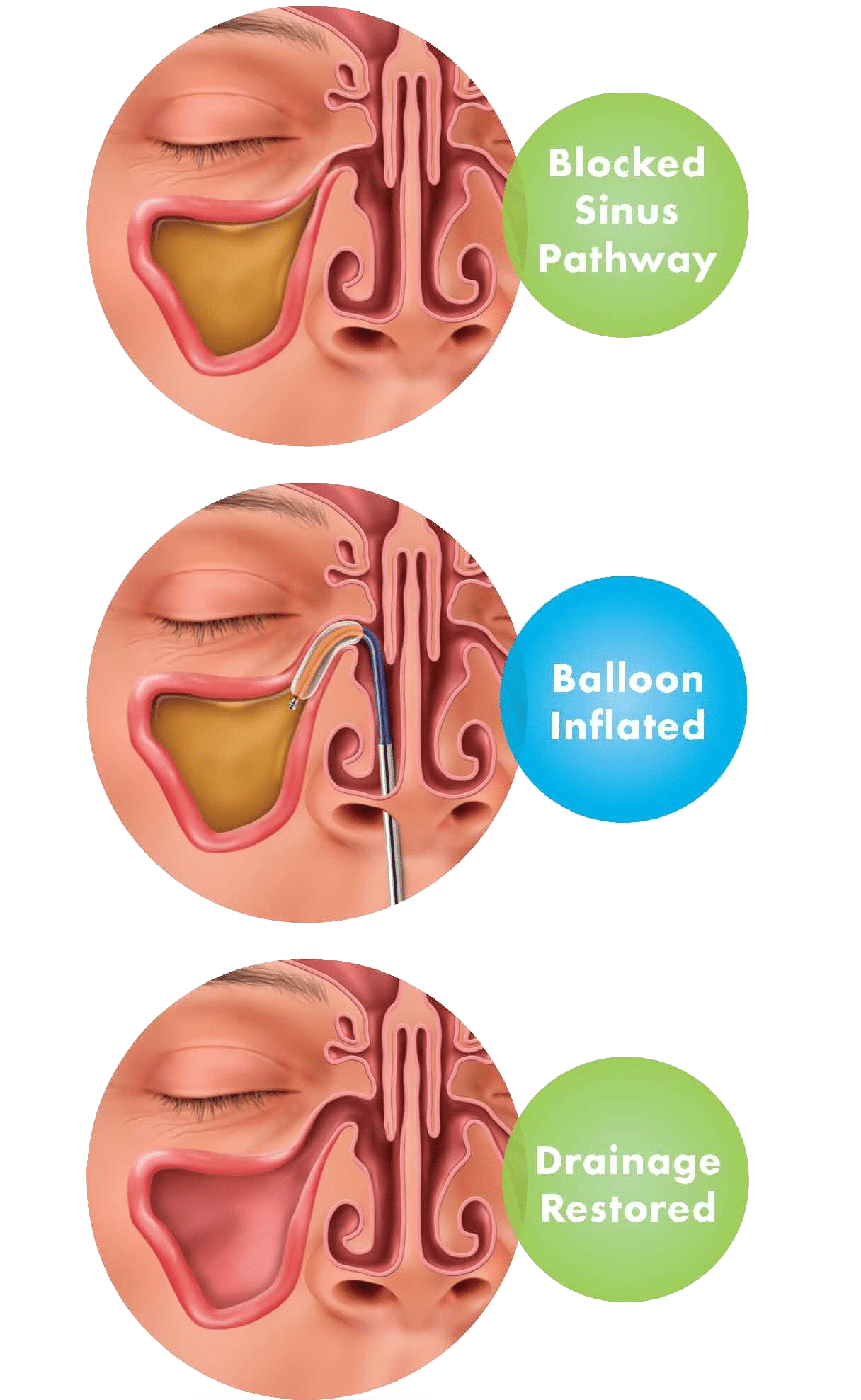blocked sinus