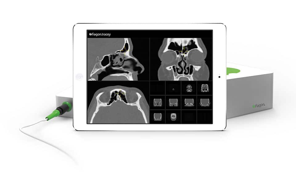 FIAGON IMAGE GUIDANCE FOR SINUS CAVITY