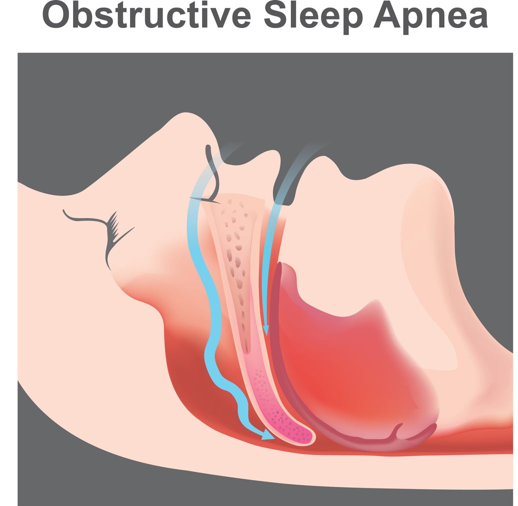 An illustrative diagram of obstructive sleep apnea