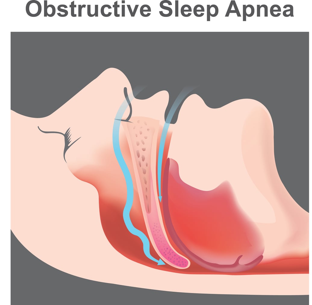 Sleep Apnea Symptoms Festus MO