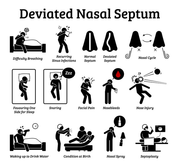 deviated septum image st. louis sinus center