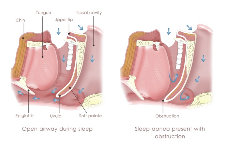 Snoring And Sleep Apnea Treatment Festus MO