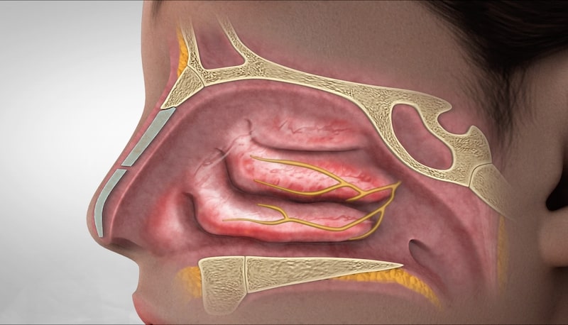 side view cross section of human nose and sinuses inflamed from rhinitis