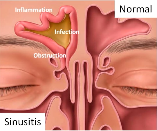 illustrated cross section of human sinuses, one infected and filled with mucus, one normal