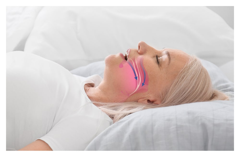 Sleep Apnea Treatment Festus MO