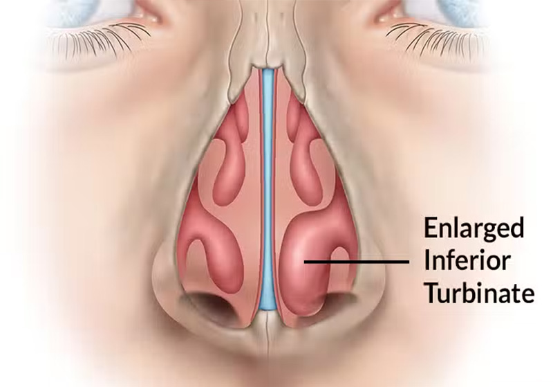 st-louis-turbinate-reduction-007