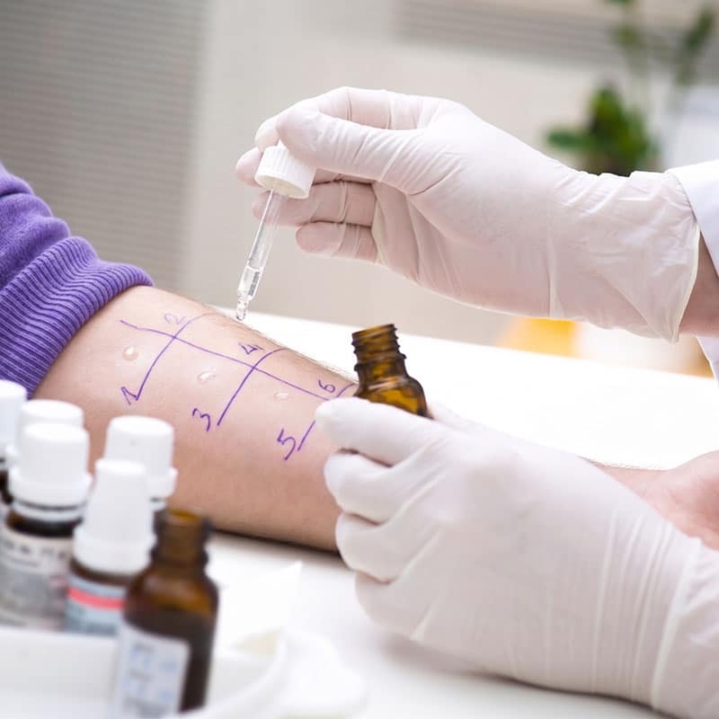 Allergy Testing
